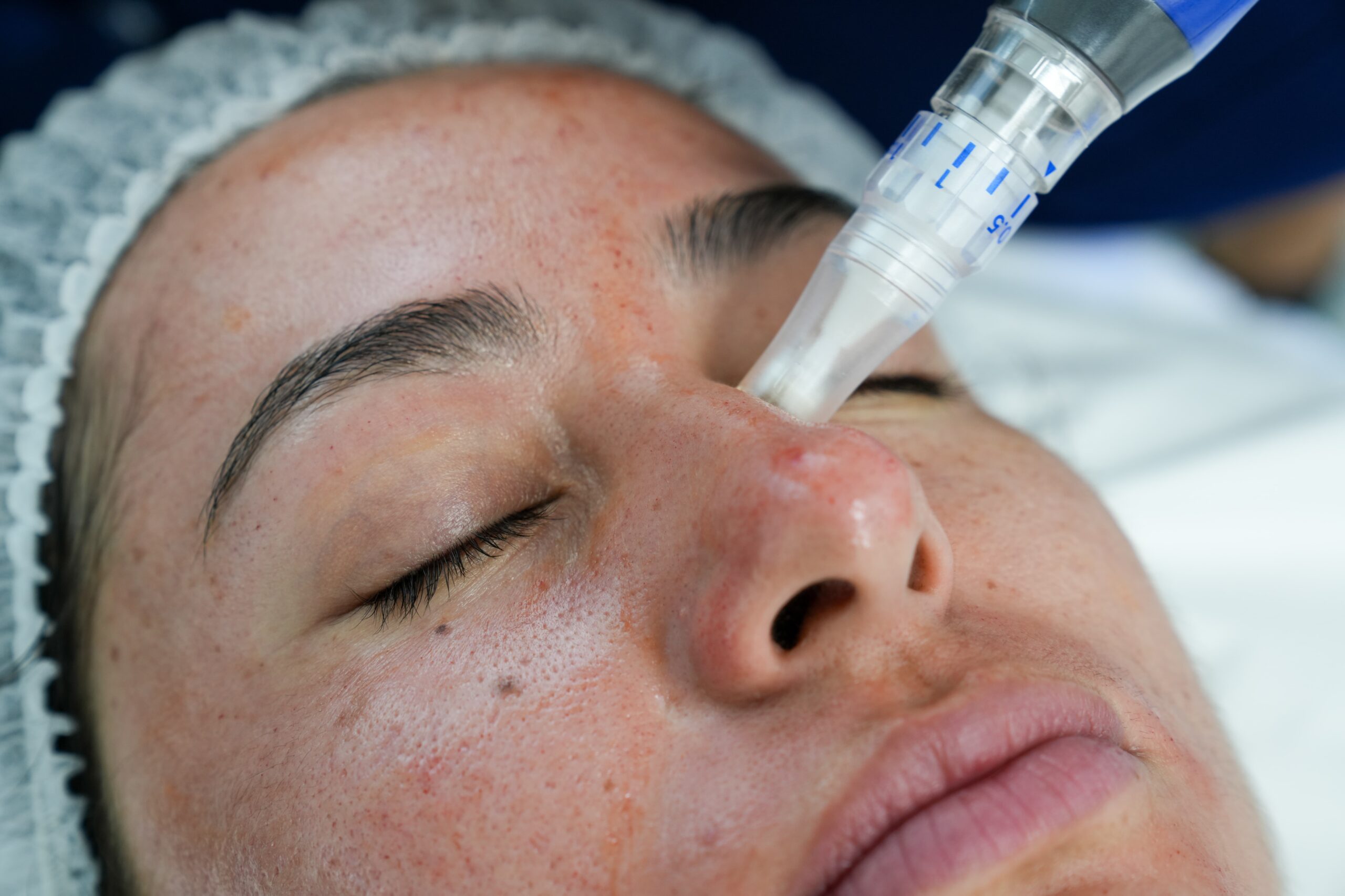 Microneedling X Hyaluronic Acid (1)