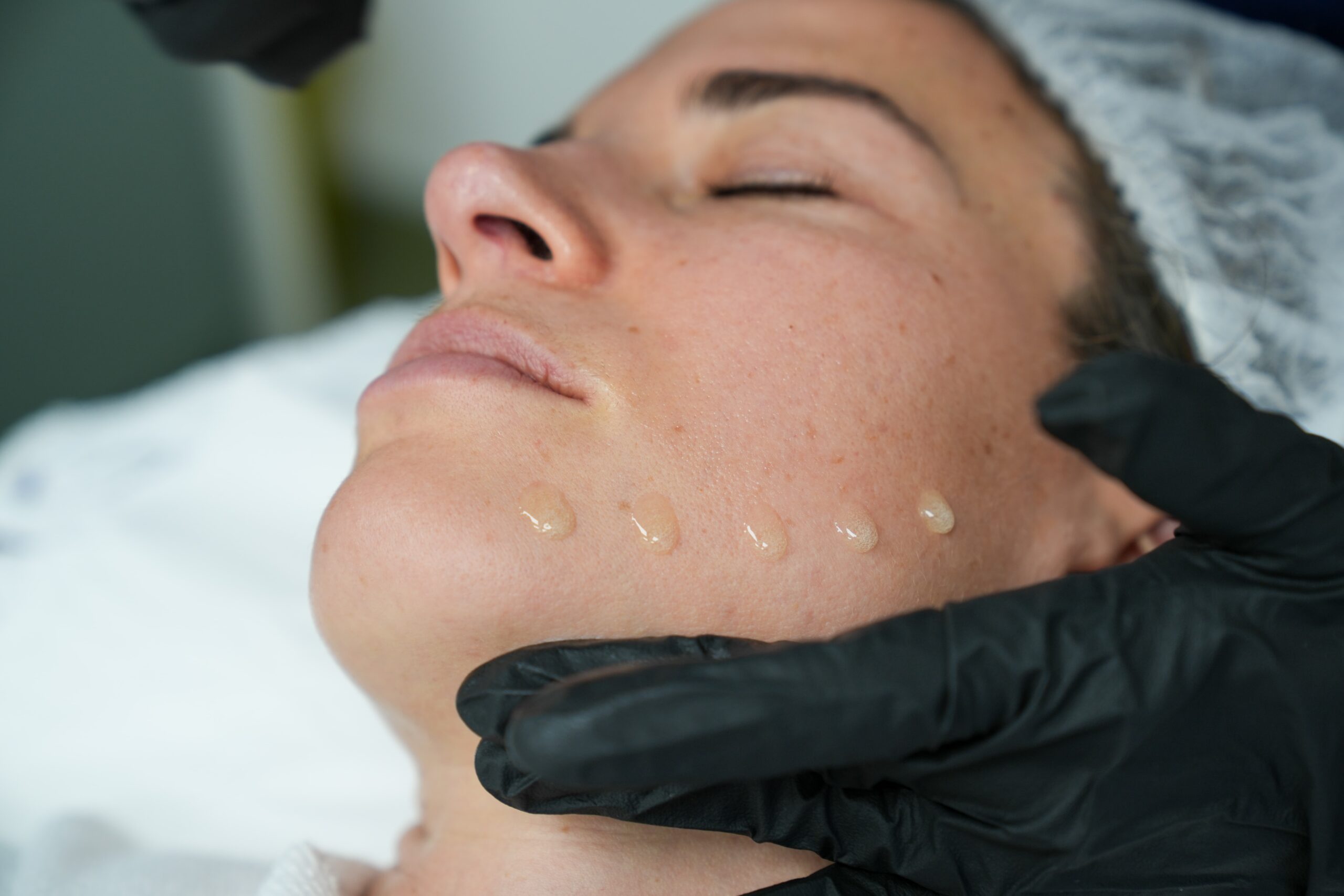 RF Microneedling x Hyaluronic acid (1)
